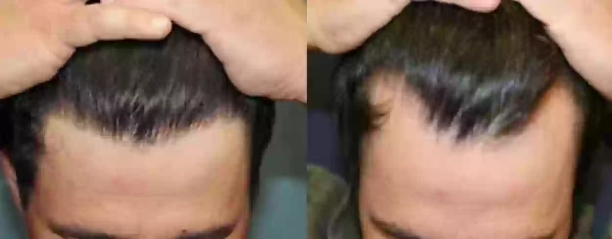 تجربتي مع زراعة الشعر في جدة