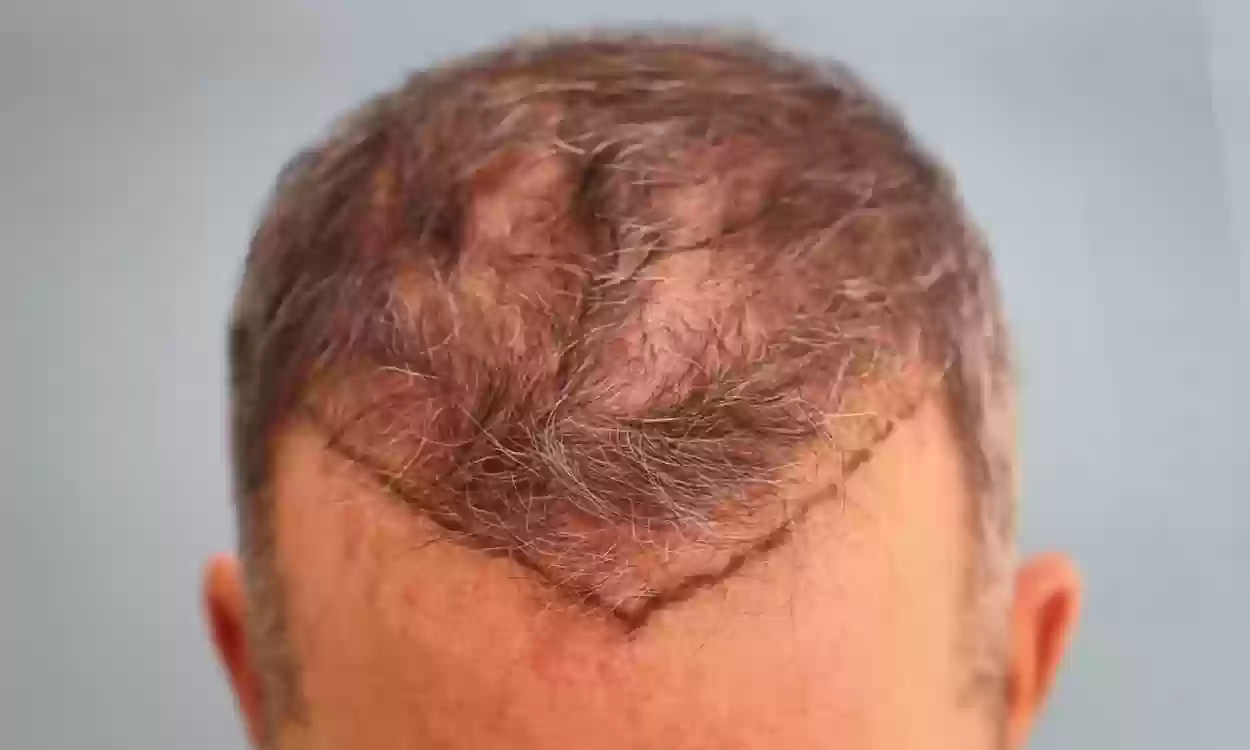 زراعة الشعر بالتقسيط في السعودية صارت متاحة!! كم تكلف زراعة الشعر في السعودية